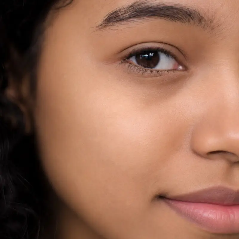 Acne after treatment