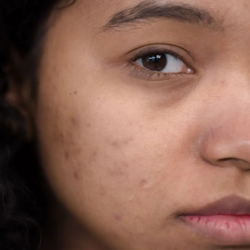Acne before treatment