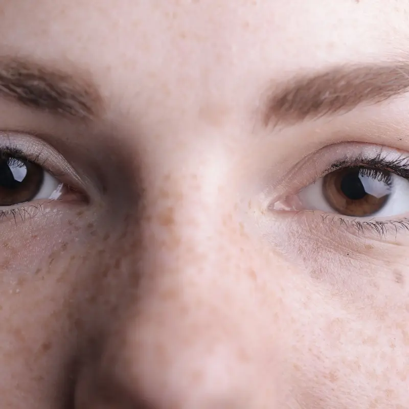 Pigmentation before treatment